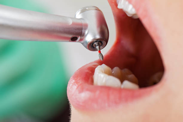 Best Emergency Root Canal Treatment in Lucasville, OH